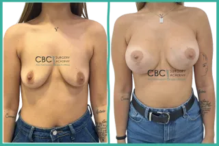 📚Corrección de contorno mamario mediante transposición de grasa