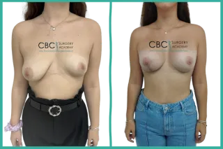 👉Corrección asimétrica mamaria mediante mastopexia combinada