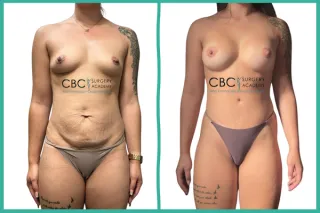 📝 Mastopexia y Abdominoplastia: El Dominio de la Cirugía Corporal Combinada