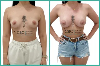 💫Aumento de Pecho con Implantes Ergonómicos + lipo Axilar