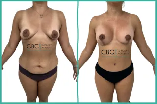 📉 Prehabilitación Nutricional en Mommy Makeover: Clave para el Éxito en Cirugías Combinadas