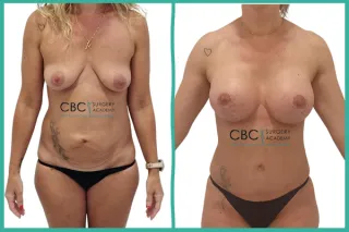 📝 Mommy Makeover en Casos de Alta Demanda: La Maestría de la Cirugía Corporal Combinada