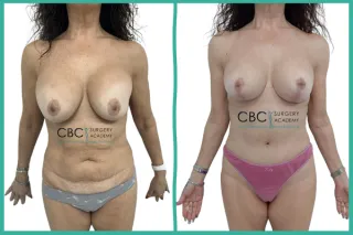 📝 Máster en Cirugía Estética: Retos en la Revisión del Contorno Corporal Post-Implantes