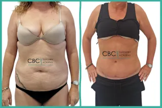 📝 Curso de Cirugía Postbariátrica y Reconstrucción: Manejo Integral de la Cicatrización en Abdominoplastia