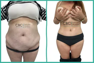 📝 Abdominoplastia Post-Pérdida Masiva de Peso con Análogos de GLP-1: Protocolo Integral y Manejo de Dehiscencias