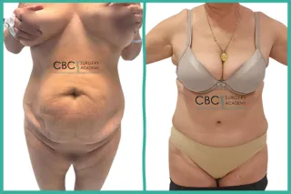 📝 Abdominoplastia Reconstructiva en Paciente de 64 años: Protocolo Integral "Nutrición personalizada" y Resultados a Largo Plazo