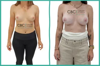 📝 Mastopexia Periareolar y Corrección de Asimetría: El Arte de Seleccionar Implantes Diferentes