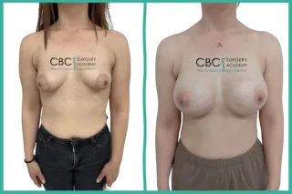 📝 Técnicas Avanzadas en Mama Tuberosa: Mastopexia Híbrida y el Desafío del Esternón Ancho