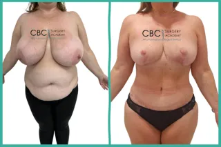 📝 Mommy Makeover Post-Pérdida Ponderal: Gestión de Dehiscencias Complejas y Terapia de Presión Negativa (PICO 7Y)