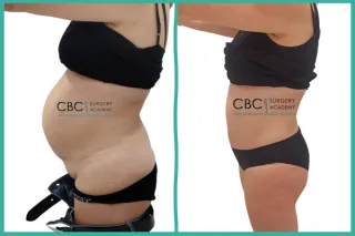 📝 Abdominoplastia Funcional y Herniorrafia Umbilical: Reparación de Diástasis Severa en Normopeso