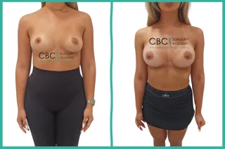 📝 Mastopexia Periareolar y Simetrización Post-Lactancia: El Desafío de los Grandes Volúmenes en CBC Academy