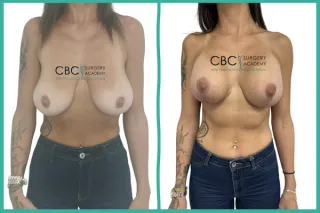 📝 Mastopexia Reductiva y Gestión de la Cicatrización Activa