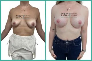 📝 Mastopexia en T Invertida: Restauración del Volumen y la Proyección Post-Lactancia