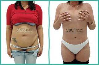 📝 Caso Clínico: Abdominoplastia, Nutrición y Manejo de Complicaciones Vasculares