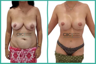 📝 Abordaje Integral del Contorno Corporal: Mommy Makeover y el Dilema del Escote