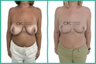 📝 Reducción Mamaria Extrema: Técnica de Injerto Libre en Paciente Fumadora