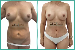 📝 Refinamiento en Mommy Makeover – Gestión de Cicatrices y Simetrización Areolar