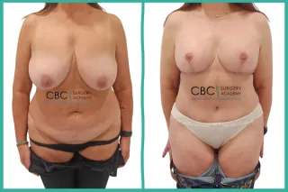 📝 Mommy Makeover y el Impacto de la Tensión Postural