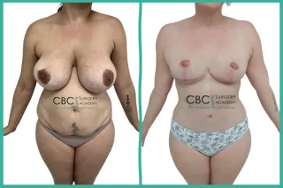 ⭐Mommy Makeover 360 y Refinamiento del Contorno Abdominal