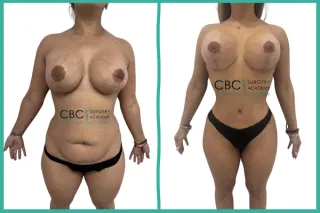 ⭐Abdominoplastia con Malla y Mastopexia de Alta Proyección: Gestión de la Paciente Multintervenida