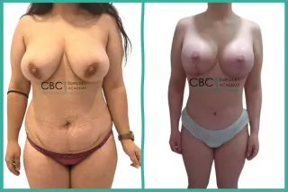 ⭐Gestión del Gran Volumen y Retracción Cutánea: Mommy Makeover con BodyTite