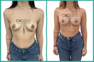 📝 Precisión en Mastopexia Periareolar: Armonía y Proyección con Técnica de Jareta