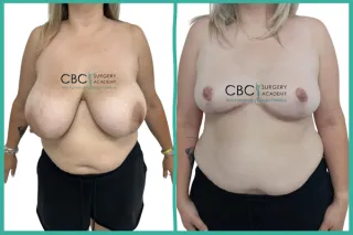 📝 Reducción Mamaria y Salud Vertebral: Manejo de la Macromastia y el Síndrome de Mondor