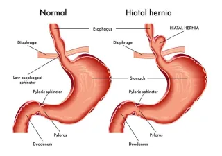 What Is Hiatal Hernia: Causes, Symptoms, & Treatment