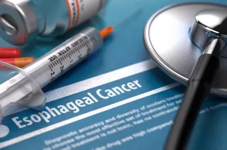 Everything To Know About Esophageal Cancer