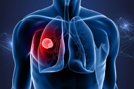 Lung Cancer Awareness Month