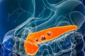 Understanding Pancreatic Cancer