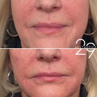 Rejuvenating the lower face is as easy as 1-2-3