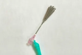 Does acupuncture hurt?