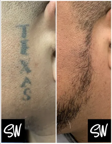 Laser Derm Med Spa at San Antonio  Get rid of your unwanted tattoo Call  us at 2109823222 to book a FREE consultation tattoo lasertattooremoval  results medspa  Facebook