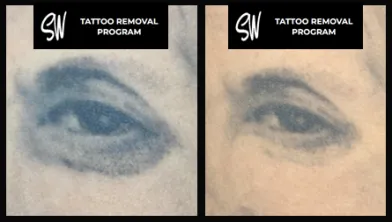 The agony of tattoo removal