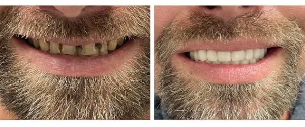 Before and after dental implants