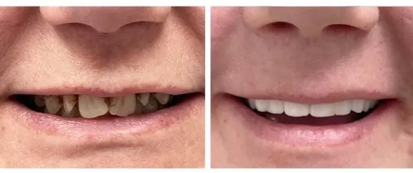 Before and after full arch restoration