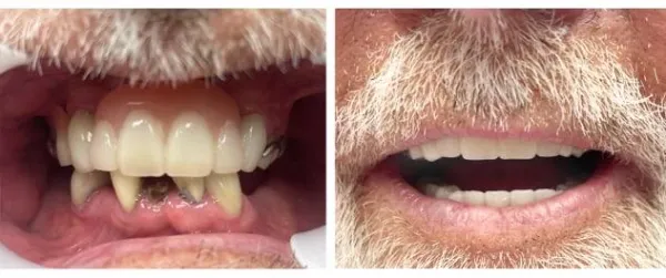 Before and after full arch restoration