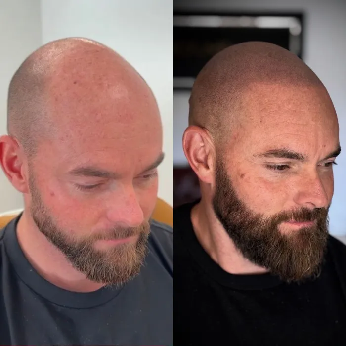 Before and after scalp micropigmentation, bearded client