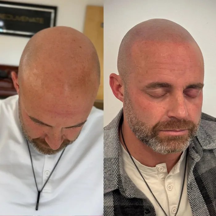 Before and after scalp micropigmentation, top of head