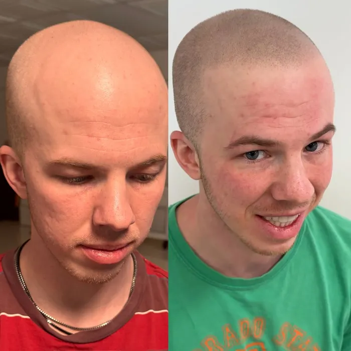 Before and after scalp micropigmentation, new hairline on a young client