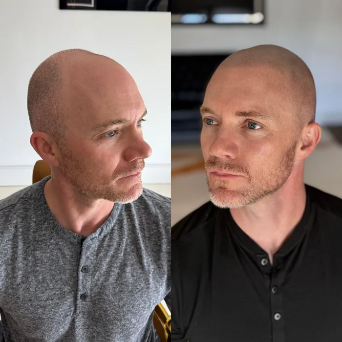 Before and after scalp micropigmentation, shaved look, side view