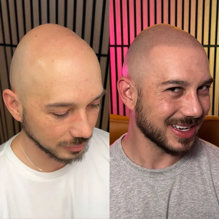 Before and after scalp micropigmentation, full shaved look