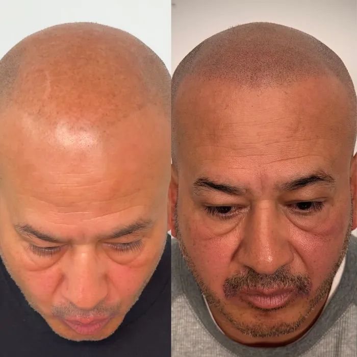 Before and after scalp micropigmentation, density for thinning hair