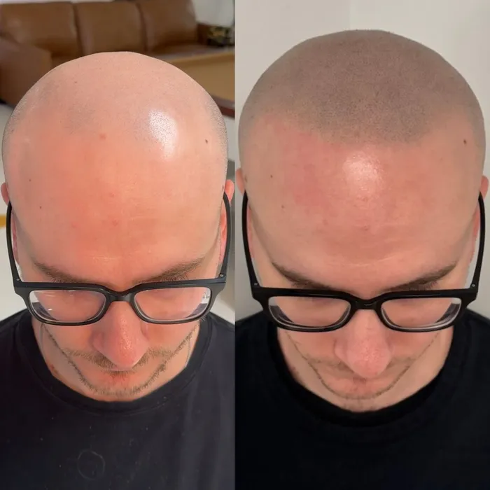 Before and after scalp micropigmentation, top view with glasses