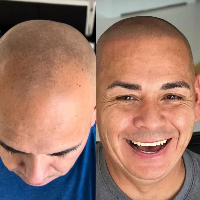 Before and after scalp micropigmentation, smiling client