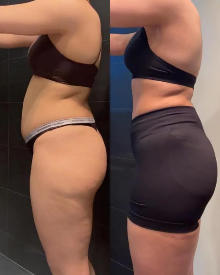 Shields-Fit client before and after