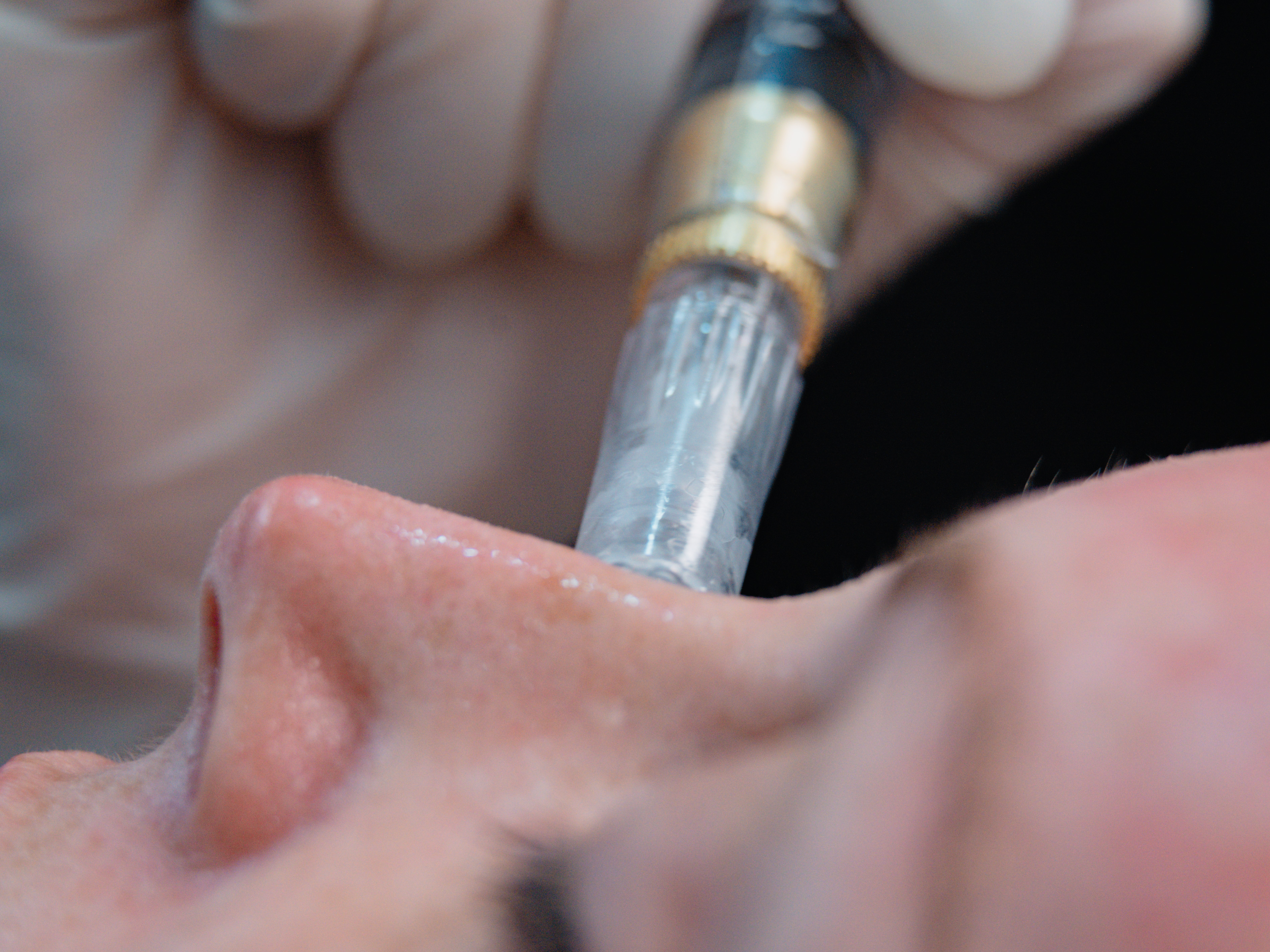 Microneedling device during a skin treatment
