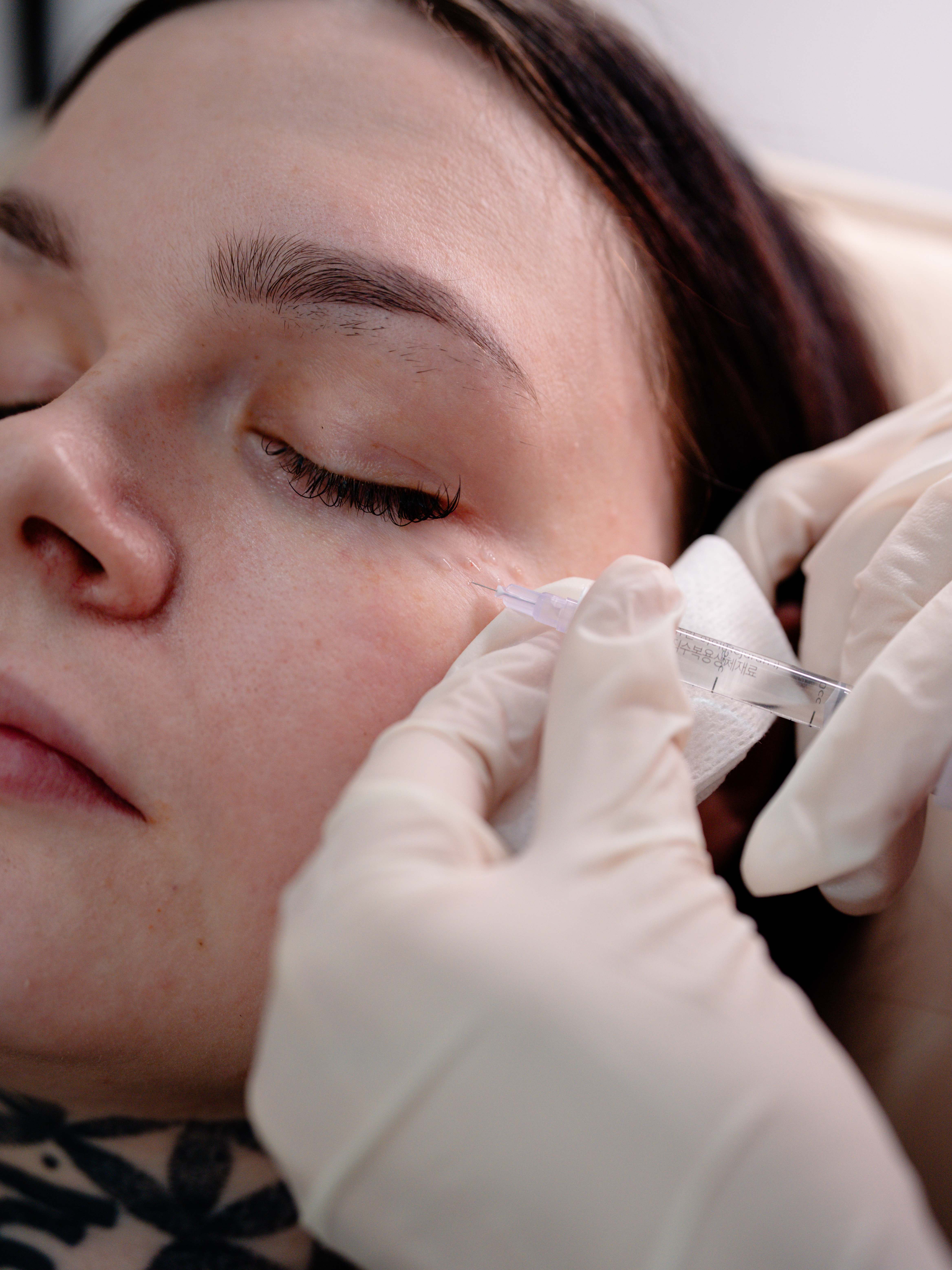 Rejuran polynucleotide skin treatment