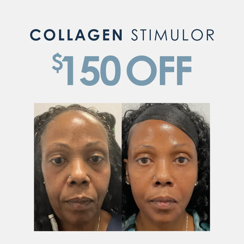 Sculptra® | $150 OFF